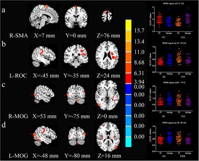 SAP97 rs3915512 Polymorphism Affects the Neurocognition of Schizophrenic Patients: A Genetic Neuroimaging Study